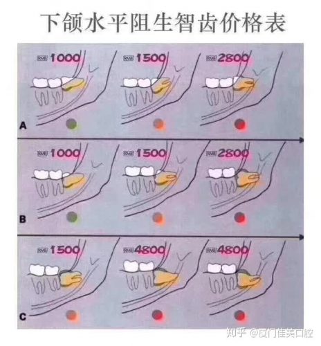 在阿根廷拔智齿是一种怎样的体验